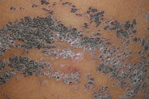 Epidermolytic nevus