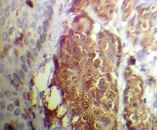granular cell tumour