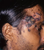 Carcinoma in EDV