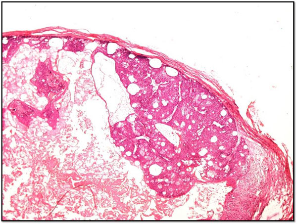 cystic sebaceous carcinoma