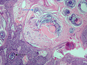 panfolliculoma2small