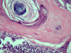 panfolliculoma3s